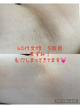 トーニングルーム(Toning room)/ワキ脱毛５回目☆