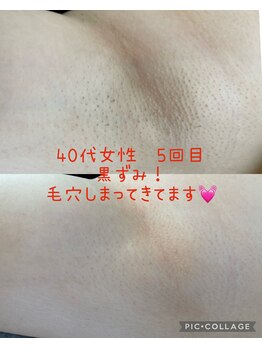 トーニングルーム(Toning room)/ワキ脱毛５回目☆