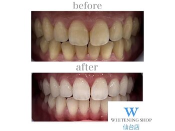 ホワイトニングショップ 仙台店/【ビフォーアフター】美白
