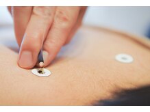 アルバ暁子鍼灸治療院(alba暁子鍼灸治療院)/お灸