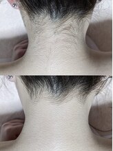 ドルチェ(Dolce)/うなじ脱毛《before after》