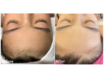 セラス(CERAS)/女性おでこ脱毛