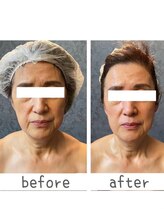 トモズサロン28(Tomos.salon.)/ほうれい線、しわ改善！