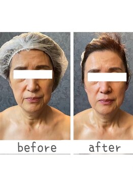 トモズサロン28(Tomos.salon.)/ほうれい線、しわ改善！