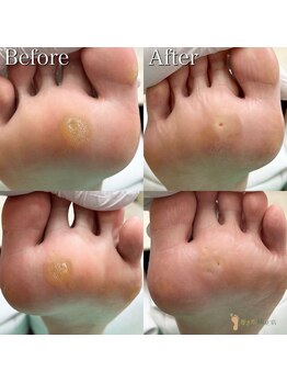 巻き爪補正店 久留米店/タコ/魚の目/角質ケア