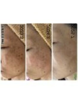 アップル 御幸ヶ原店(Apple.)/肌質改善プログラム