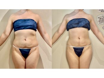 カルナ(CARNA)/【痩身】セルライトゼロ2