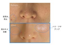 モモ(MOMO)/肌質別ピーリング♪