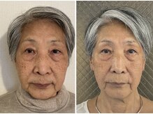 エム ビューティー(M Beauty)/セルラム　ビフォア＆アフター