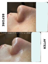 ジーンバイピエル 中野店(gene by PIEL)/#毛穴ケア#ピーリング#ワックス