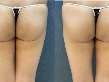 ビーホープ(B.hope)/30代モニター様3回目