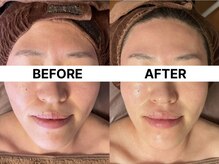 ハーブピーリング 恵比寿/浮腫み改善/毛穴引締ハーブ