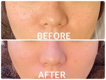 ハーブピーリング 恵比寿/毛穴/くすみ/ざらつき/肌質改善