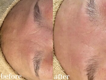 ホワイトアクア 北千住店(WHITE AQUA)/ララピール1回/赤みしわ改善