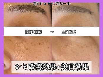 ヴィオール 名古屋栄店(VIOR)/シミ悩みは光Vショット