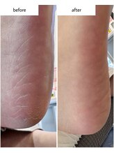 ケアプラス(care plus)/足裏角質ケア