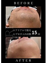 エアリアル 南行橋店/人気のヒゲ脱毛