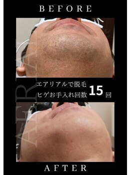 エアリアル 南行橋店/人気のヒゲ脱毛