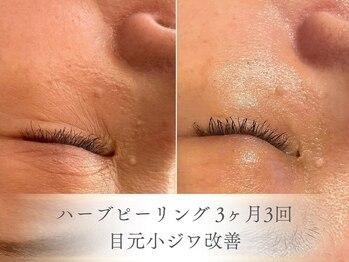 ベルペール(Belle perle)/【ハーブピーリング】毛穴/シミ