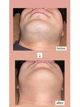 オーシャンズ 谷町四丁目店(OCEANS)/鬚脱毛施術症例