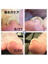 エナジー オブ グレース(energy of grace)/巻き爪ケア