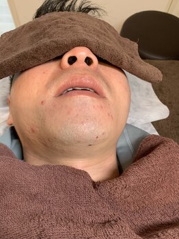 チャンス(CHANCE)/ヒゲ脱毛のお客様♪