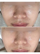 ソワナ(soina)/【神楽坂駅/フェイシャル/毛穴】