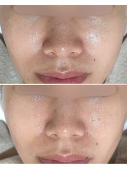 ソワナ(soina)/【神楽坂駅/フェイシャル/毛穴】