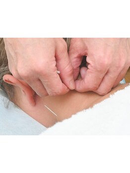 鍼灸施術を受けたい