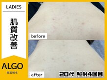 アルゴ 豊中岡町駅前店(ALGO)/【美肌全身脱毛】
