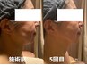 【再来】艶爆誕★★★韓国肌管理｜幹細胞培養上清液導入で水光ツヤ肌へ