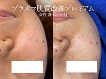 エイトスキン(8skin)/プラズマ/毛穴洗浄/乳酸菌パック