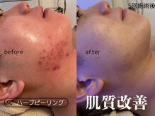 クオーレ 福津(cuore)の雰囲気（メンズハーブピーリングでニキビケア肌質改善◎）
