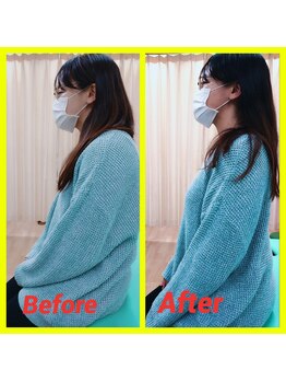 アスミルはり灸接骨院/猫背矯正