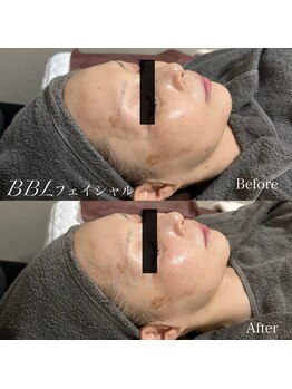 エレーナ(ELENA)/BBLフェイシャル
