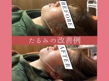 エクラ(Eclat)の雰囲気（美容鍼が新登場☆お悩みに合わせてたオーダーメイドの美容鍼。）