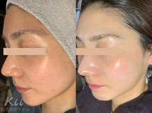 キー(kii)/月1肌管理にハーブピーリング