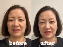 ソラナ(Solana)/美容鍼（ほうれい線・たるみ）