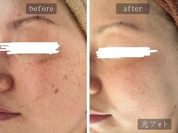 アムールサロン(Amour salon)/光フェイシャルでシミケア/新宿