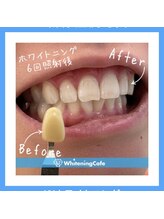 ホワイトニングカフェ 和歌山ガーデンパーク店(WhiteningCafe)/6回照射症例