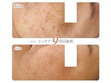 シミケア専門店O.B.M 博多阪急店/シミケア