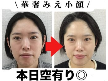 ブプラ 金池店(BUPURA)/３TS法小顔矯正効果