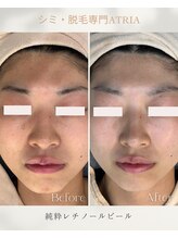 アトリア(ATRIA)/純粋レチノールピール