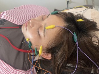 ヒップ(hip)の写真/オーダーメイド美容鍼で小顔効果はもちろん、鍼でお肌も刺激されるので潤い・弾力・ハリUP効果も◎