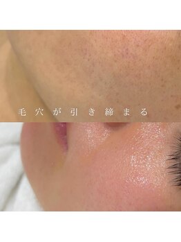 マイ フェア レディ(MY FAIR LADY)の写真/光脱毛でとり切れない【透明な産毛】を取り除き、毛穴が引き締まっていく感覚を是非お楽しみください。