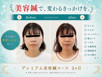 シナジープラス 水前寺店(SYNERGY+)の写真/30代から50代の小顔・たるみ・リフトアップに美容鍼を