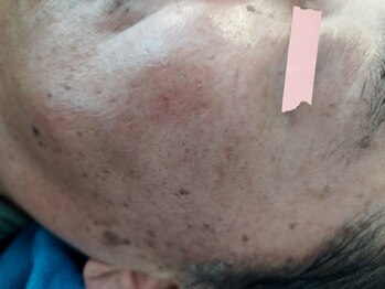 麻謝/純正レチノール　Ａｆｔｅｒ