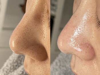 クレア(CLEA)/毛穴エクストラクション