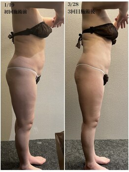 桜/セルライトゼロ