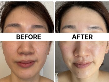 ハーブピーリング 恵比寿/浮腫み/トーンアップハーブ